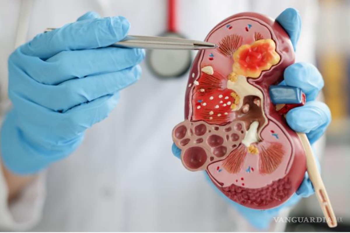 Coahuila: Es la enfermedad renal crónica una de las principales causas de muerte