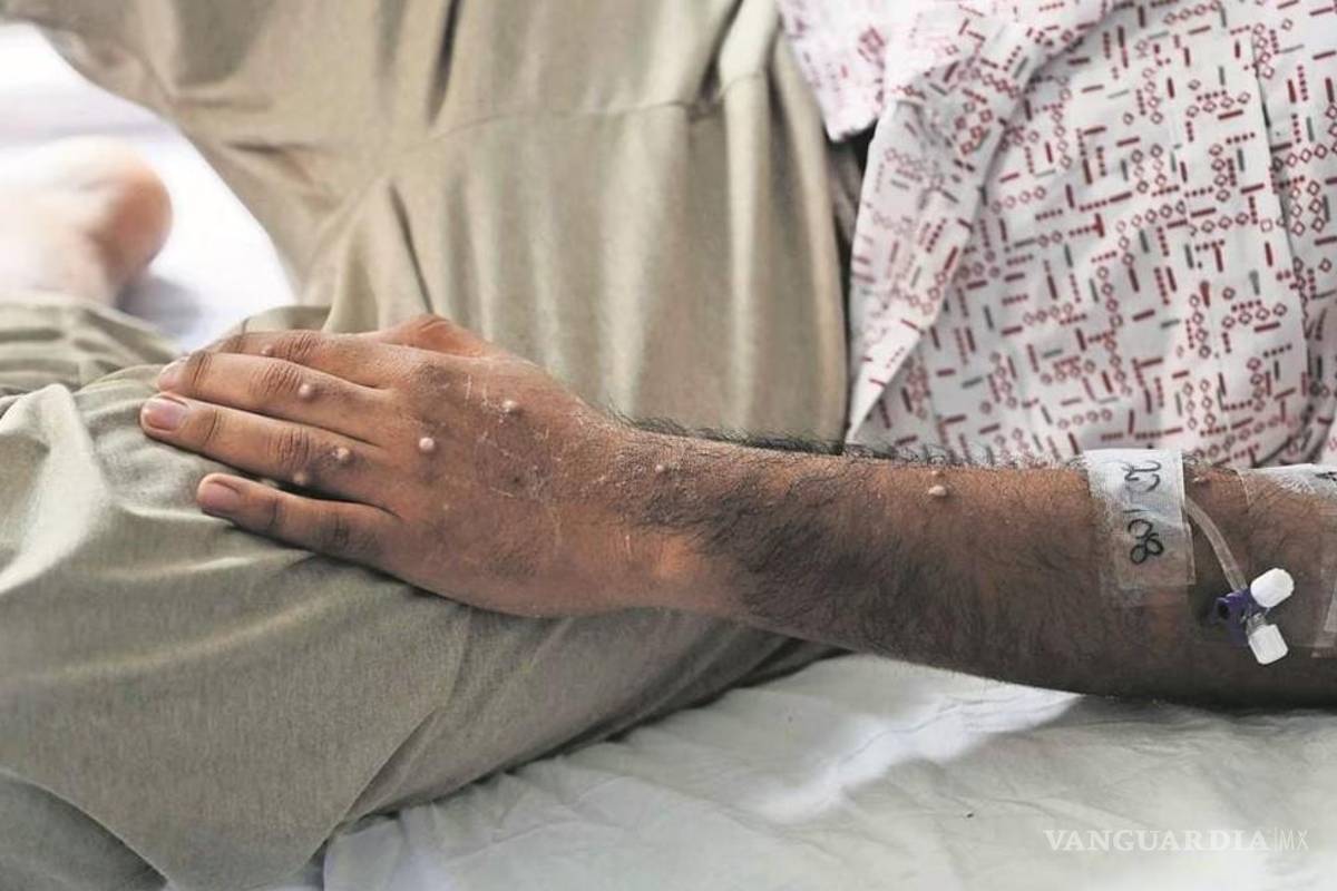 OMS declara el fin de la emergencia internacional por el brote de viruela del mono