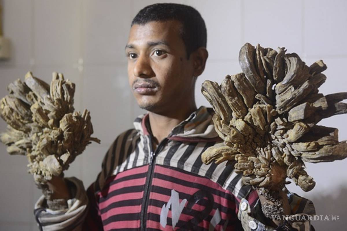 'El hombre árbol' pide amputación de sus extremidades; no soporta el dolor