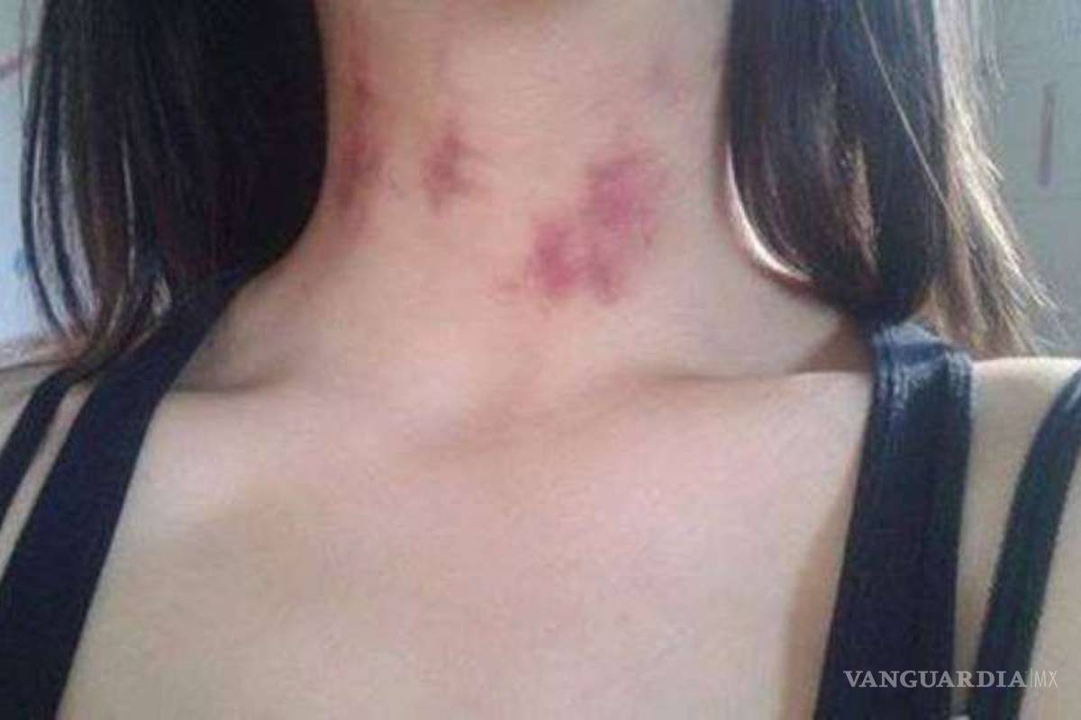 Su novia llegó con 'chupetones' en el cuello y él le creyó la peor excusa