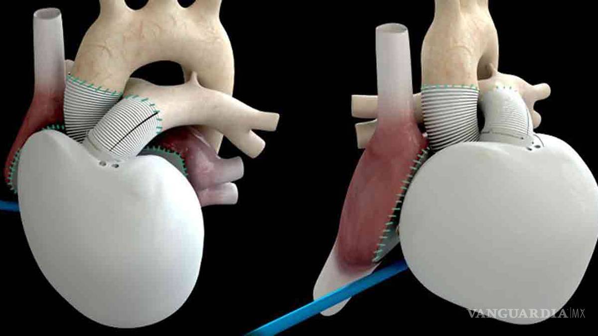 Muere paciente con corazón artificial en Francia