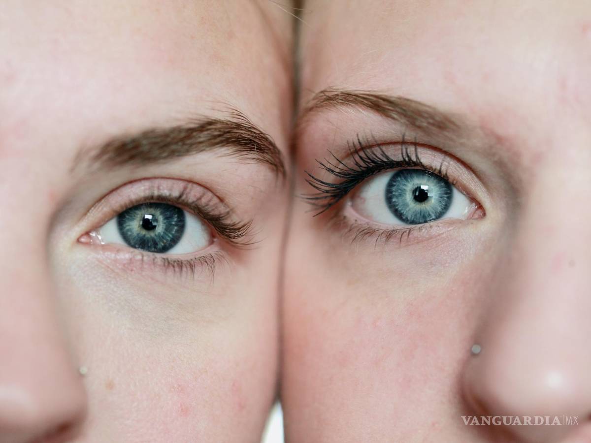 $!Las personas más propensas a padecer rosácea son aquellas de piel muy blanca, pelo rubio y ojos claros.