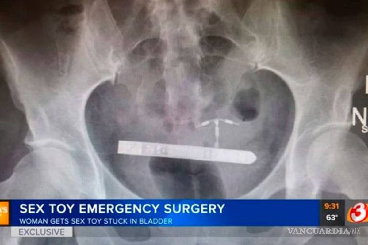 Juguete sexual llegó hasta su vejiga, tuvo que ser operada de emergencia