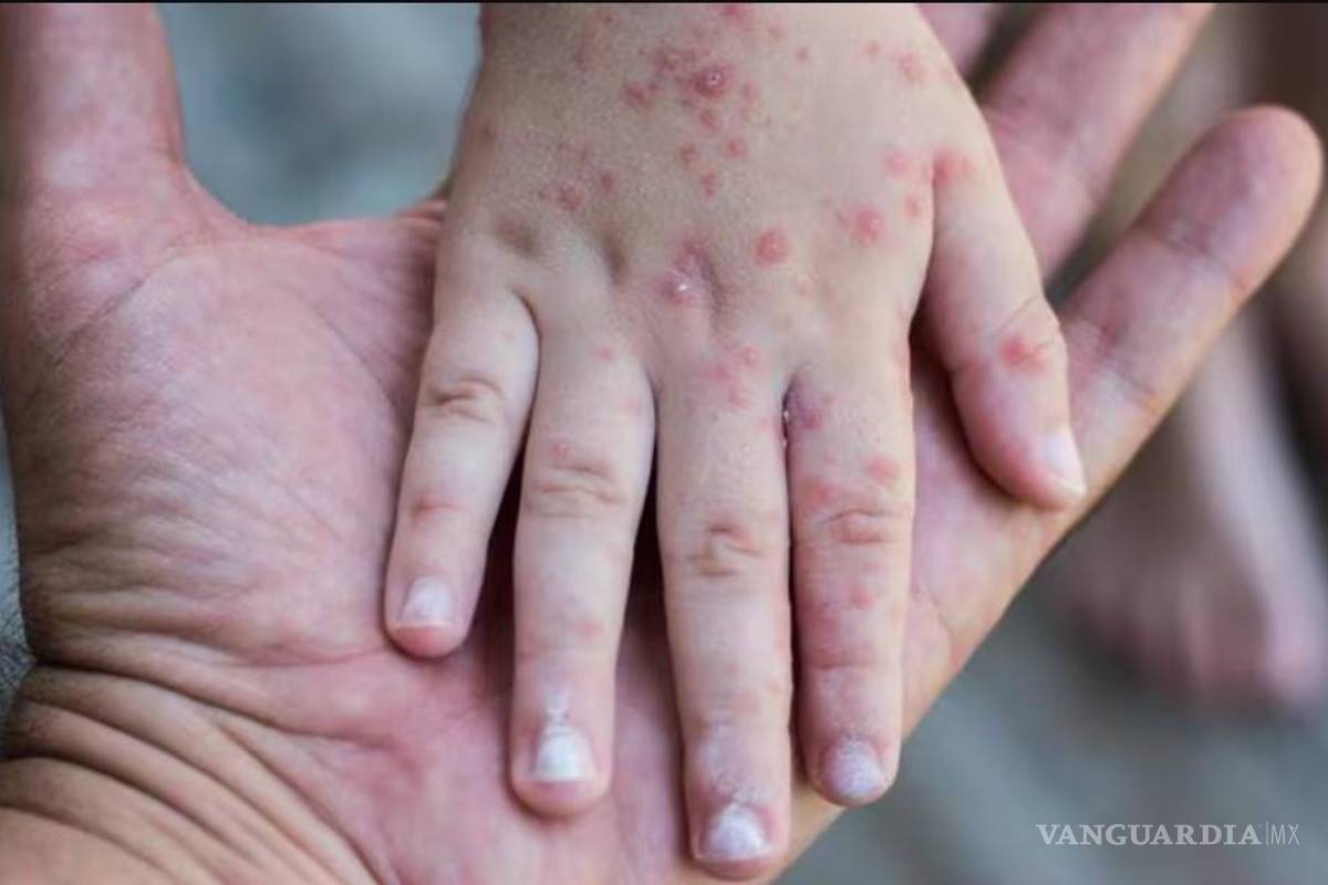 Registra Secretaría de Salud cuatro casos importados de sarampión