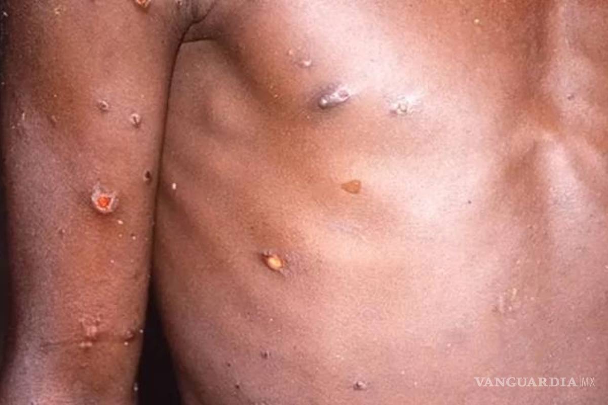 Viruela del mono pronto será declarada pandemia: experto