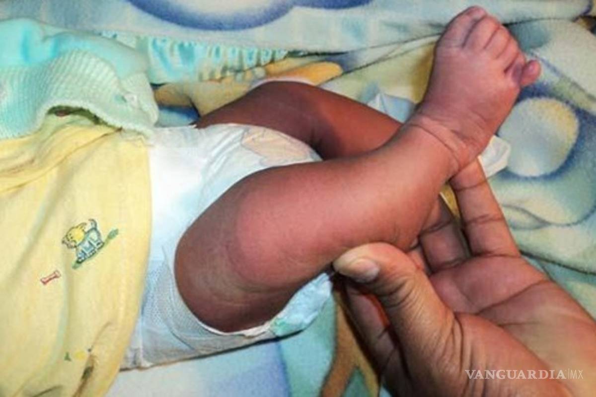 La bebé que nació con 6 dedos en cada mano y en un pie