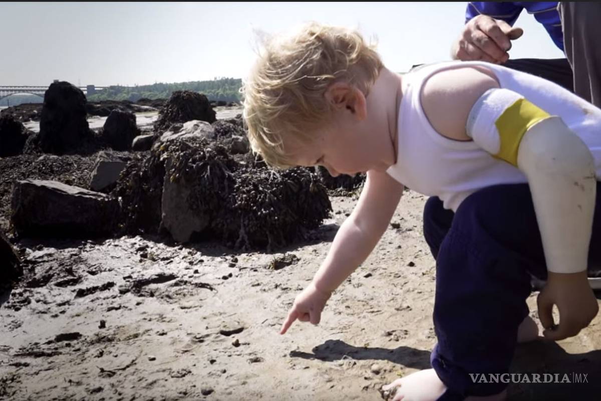 Su pequeño necesitaba una prótesis ¡Él mismo la creó!