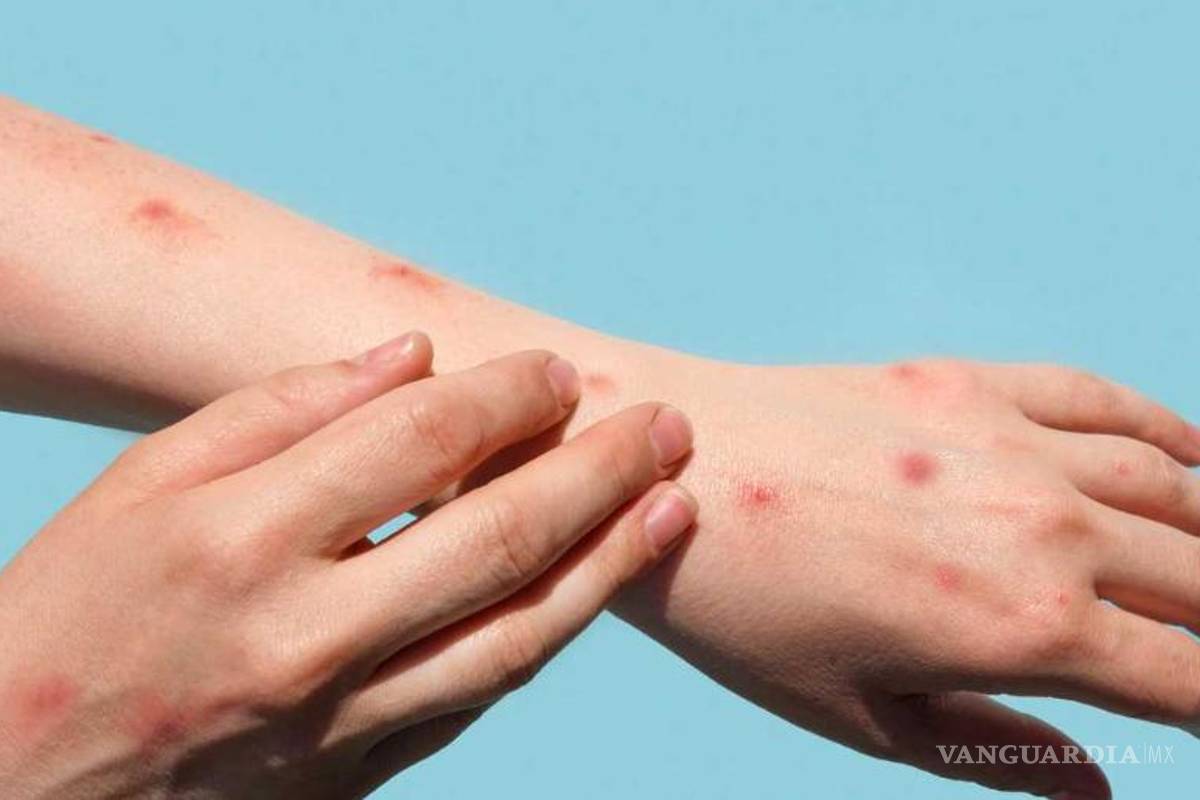 Confirman 147 contagios de viruela del mono en México