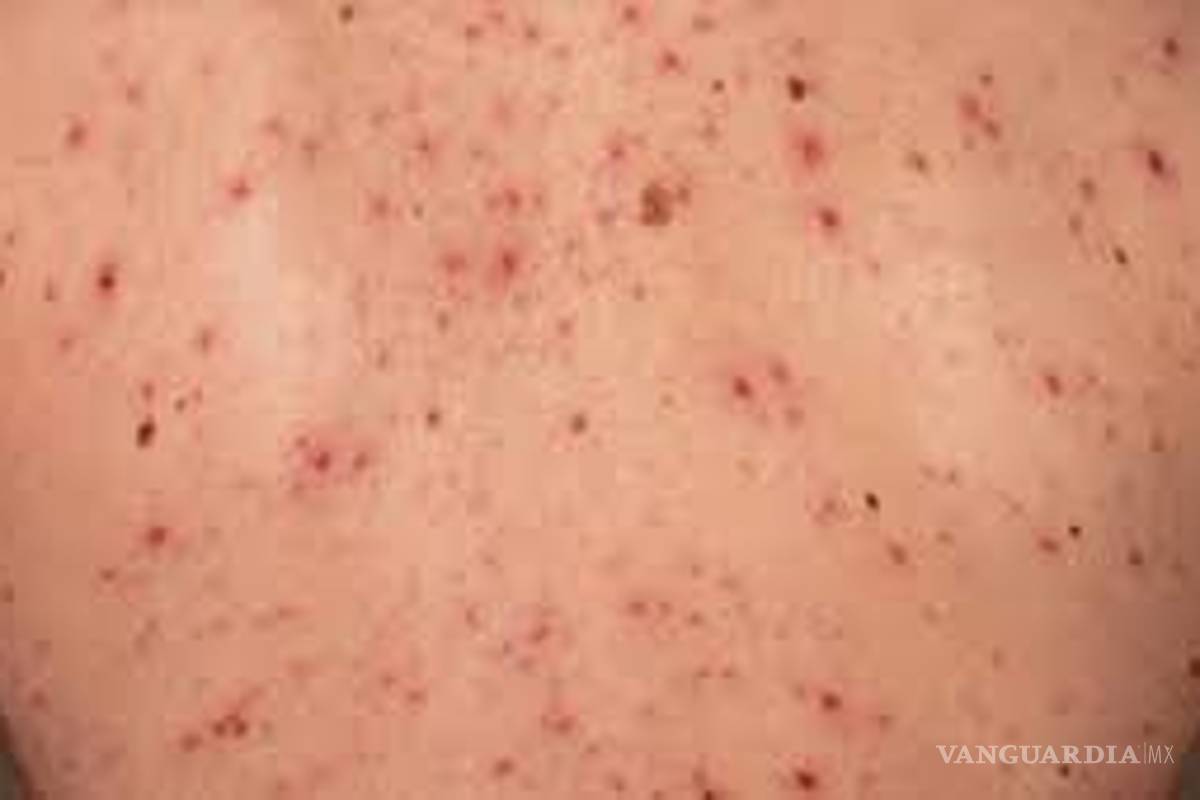 “Sarampión es mucho más contagioso que COVID-19”, asegura experto