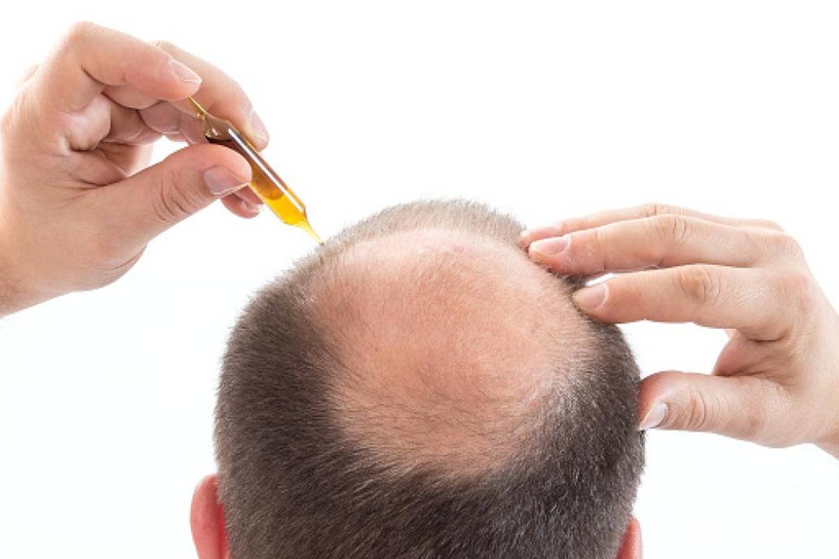 $!Calvicie: el terror en la 'azotea' que nadie quiere experimentar