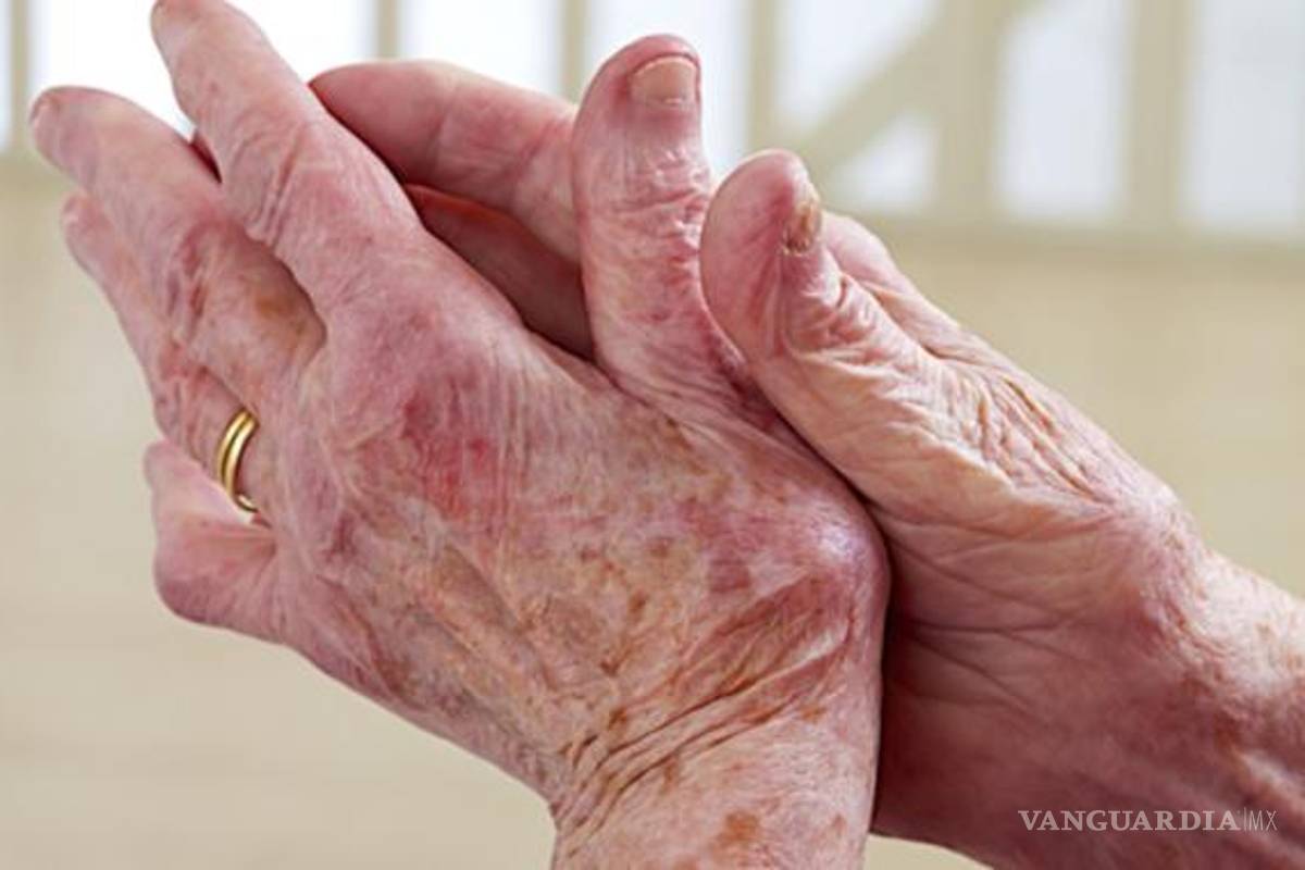 La necesidad de visibilizar a las personas con lupus