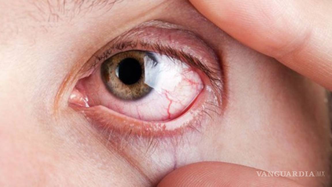 Cuatro de cada 100 mexicanos pueden desarrollar glaucoma