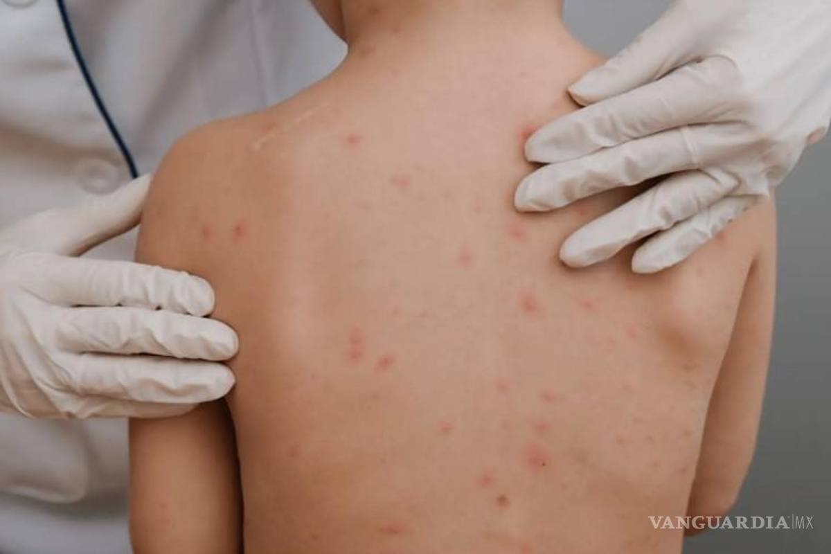 Brote de varicela en primaria de Piedras Negras deja 9 alumnos en aislamiento