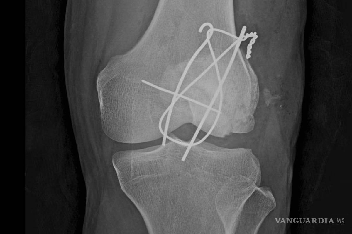 $!La drag queen Genn Taft resultó gravemente herida tras un choque en Uber Moto; acusa que el conductor se quedó dormido y que aún no recibe reembolsos médicos.