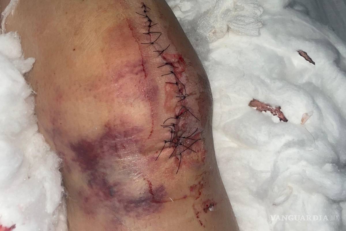 $!Genn Taft sufrió una fractura expuesta en un accidente de Uber Moto y reclama falta de apoyo económico de la plataforma y la aseguradora.