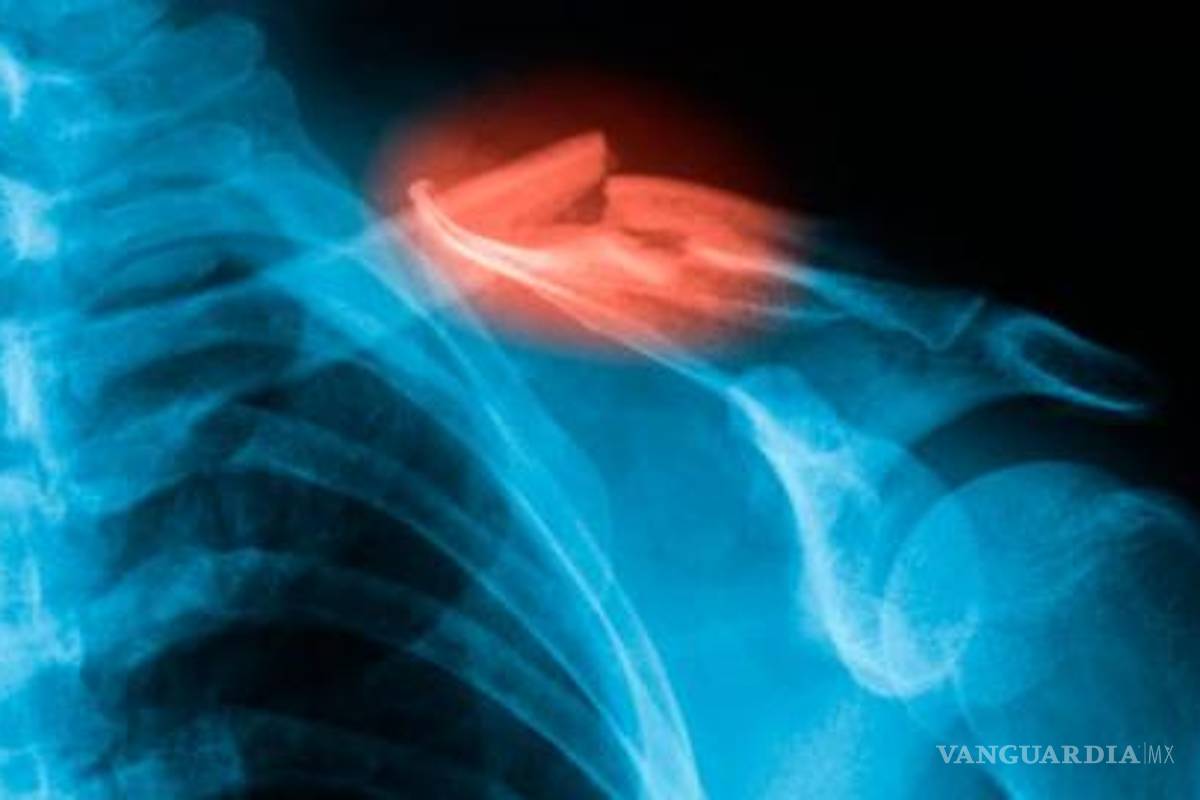 Mexicanos crean un biopolímero que regenera hueso más rápido