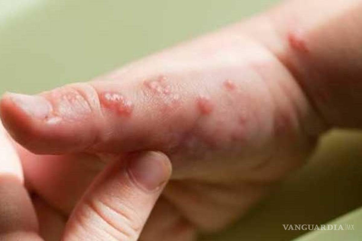Alertan posible caso sospechoso de viruela símica en Nuevo Laredo, Tamaulipas