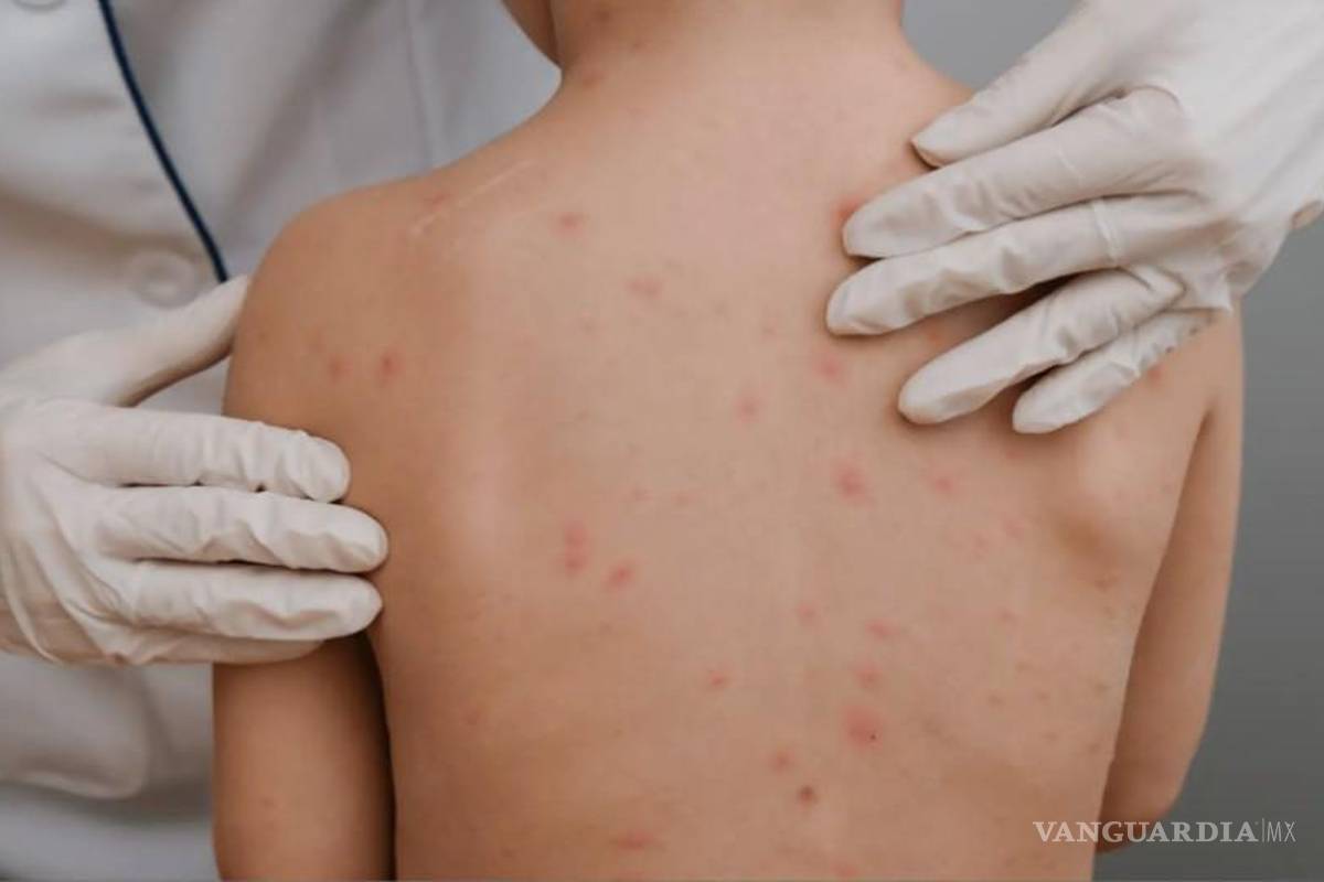 Coahuila: Sedu y SS aplicarán medidas preventivas ante contagios de varicela