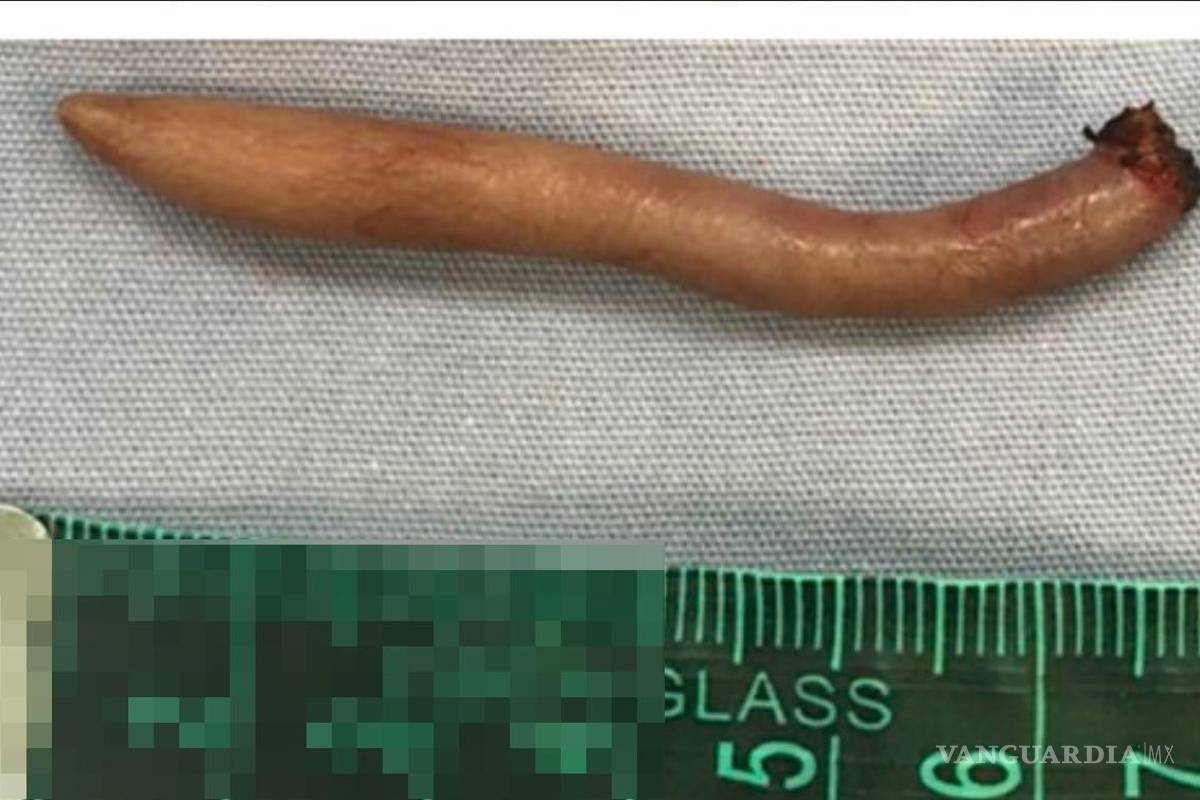 Nace en Nuevo León bebé con cola de 5.7 centímetros de largo, documenta revista médica