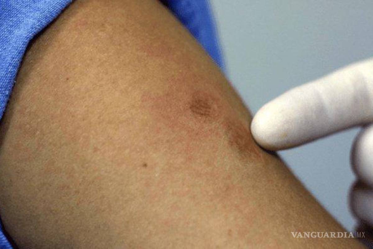 Captan turista con viruela del mono en Puerto Vallarta... y se les escapa a Estados Unidos