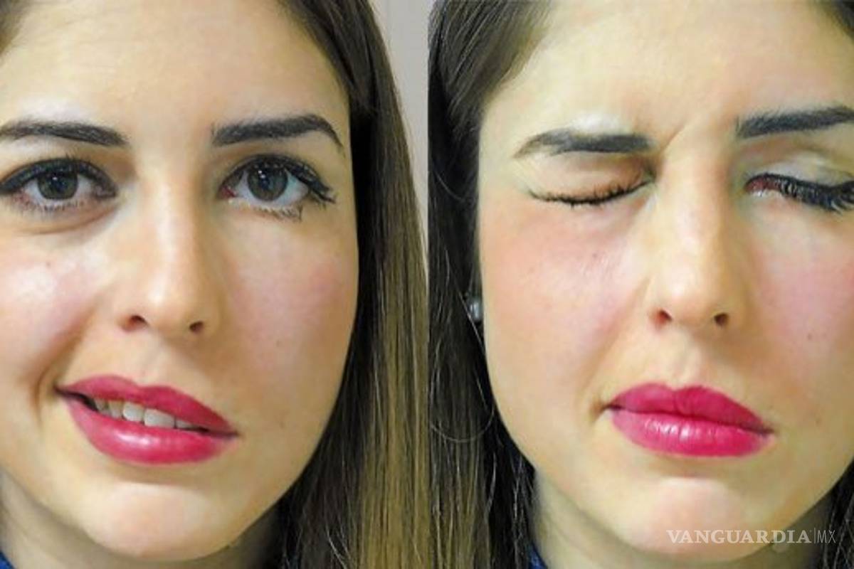 Atención, estas son las cinco causas que producen una parálisis facial