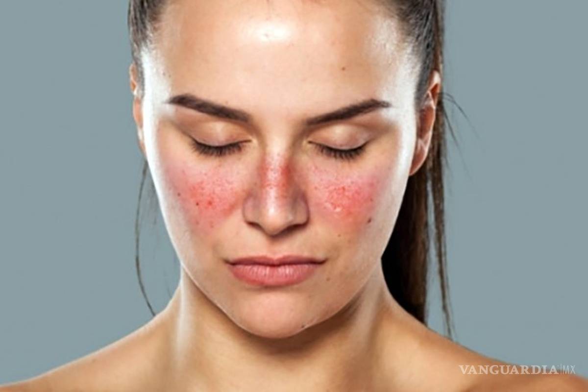 Lupus, enfermedad con alta prevalencia en México