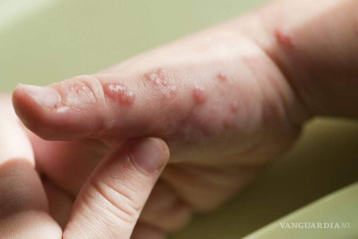 Alerta mundial... ¿Qué es la gripe del tomate y cuáles son sus síntomas?