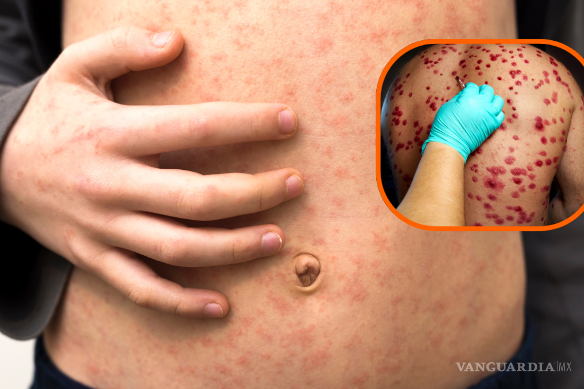 La epidemia de sarampión en los Estados Unidos se extendió a más 1000 casos