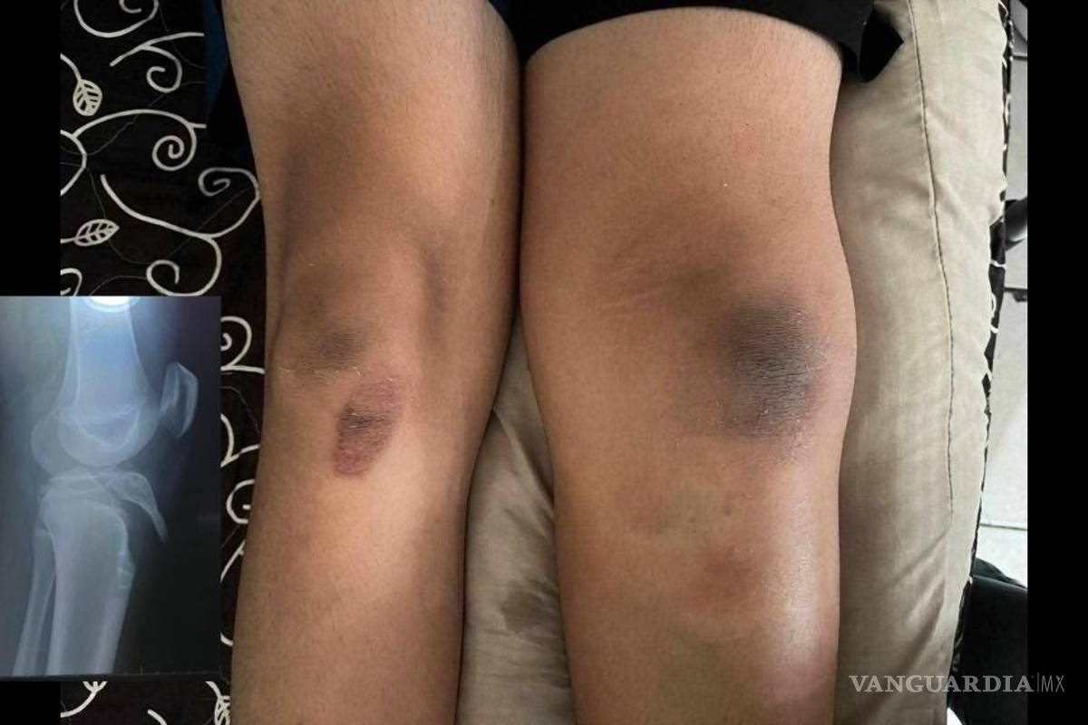 Saltillo: estudiante sufre grave lesión en instituto; familia denuncia negligencia