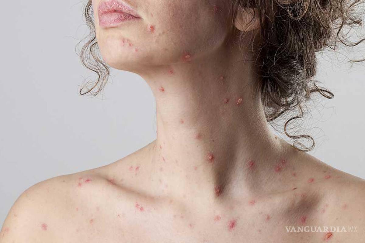 Suma España 59 casos de viruela del mono; buscan al ‘paciente cero’