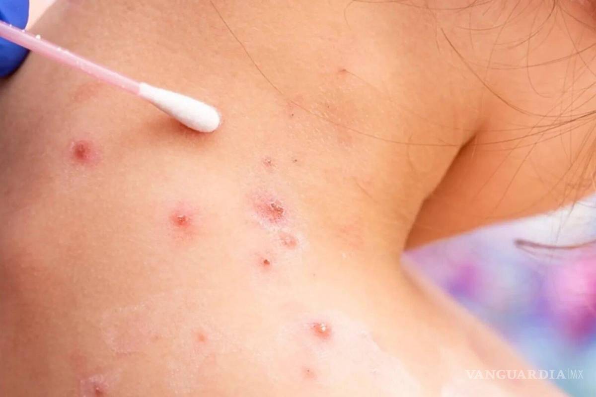 Lo que debes saber de la viruela del mono