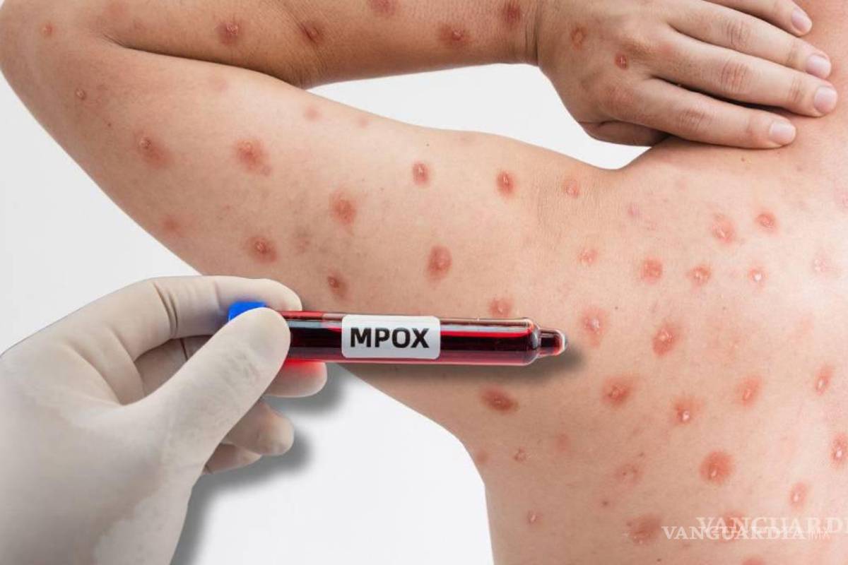 Analiza Cofepris eficacia de vacuna contra Mpox; darán dictamen en 10 días