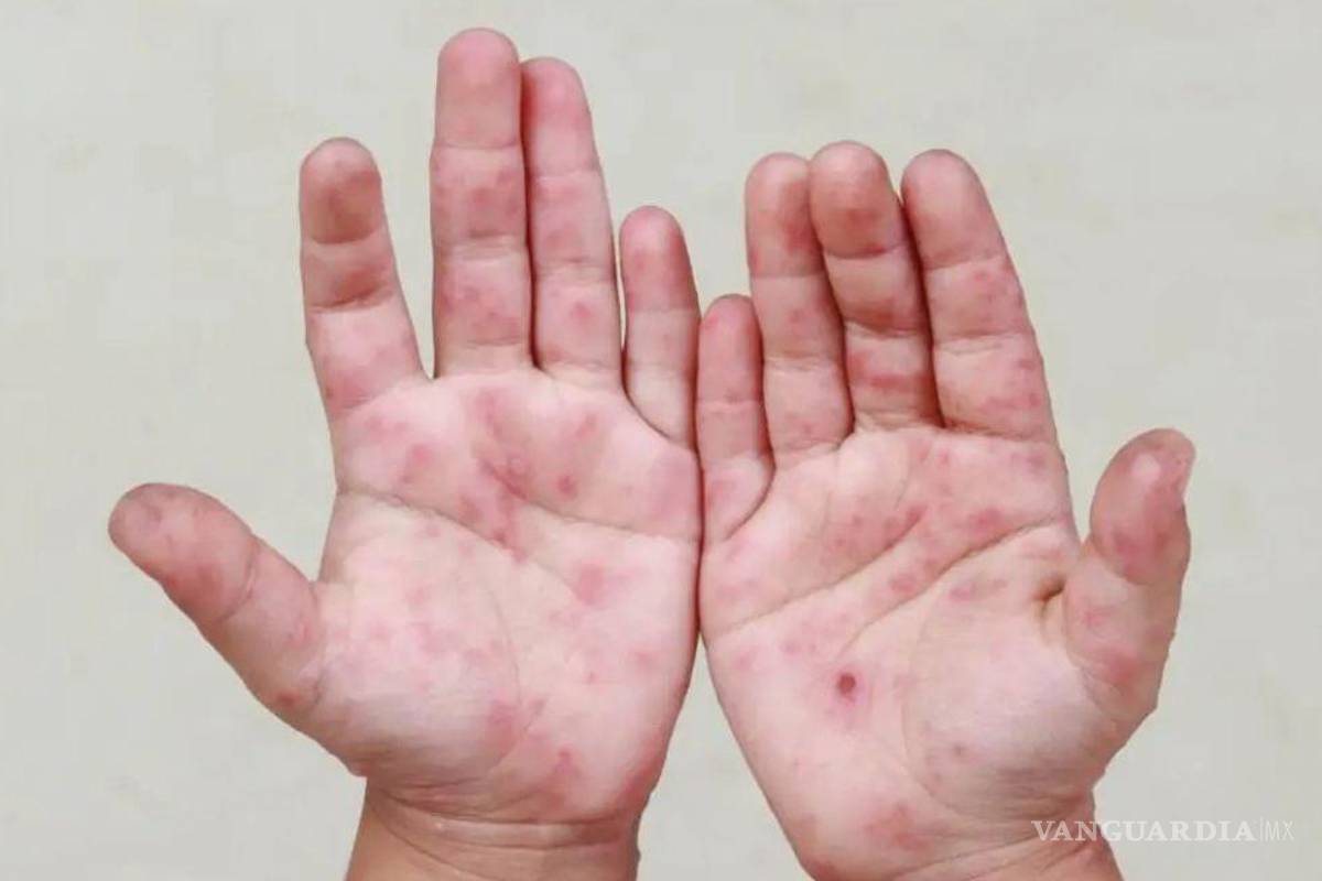 Cierran cinco grupos en preescolares de Piedras Negras por brotes del virus Coxsackie