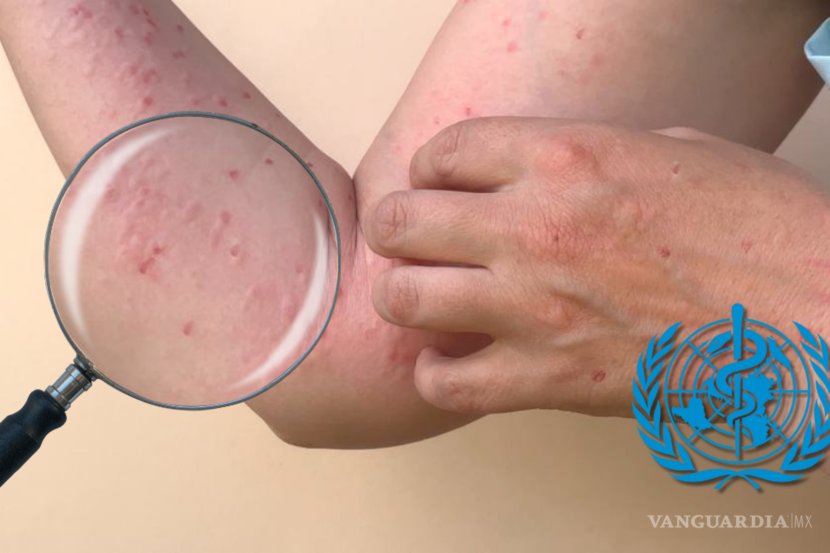 Viruela del Mono: Cómo se contagia y cuáles son sus síntomas