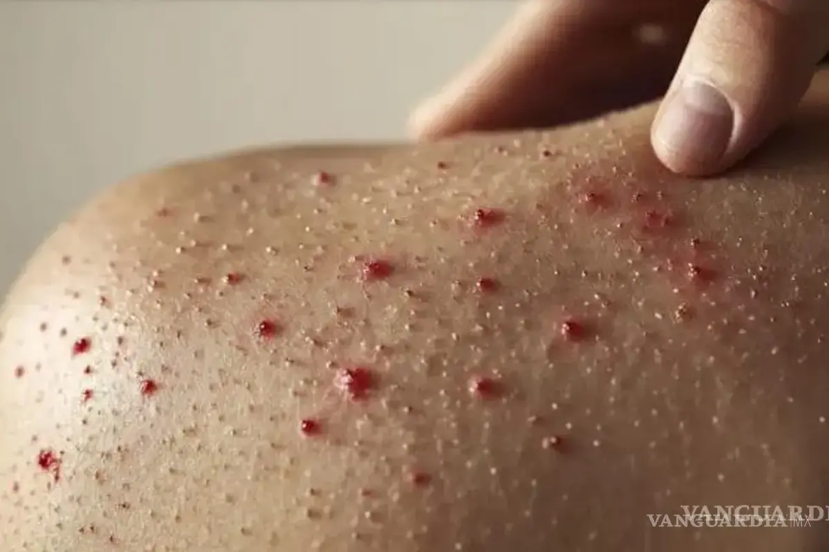 Coahuila: van en alza casos de sarampión; suman 184 probables