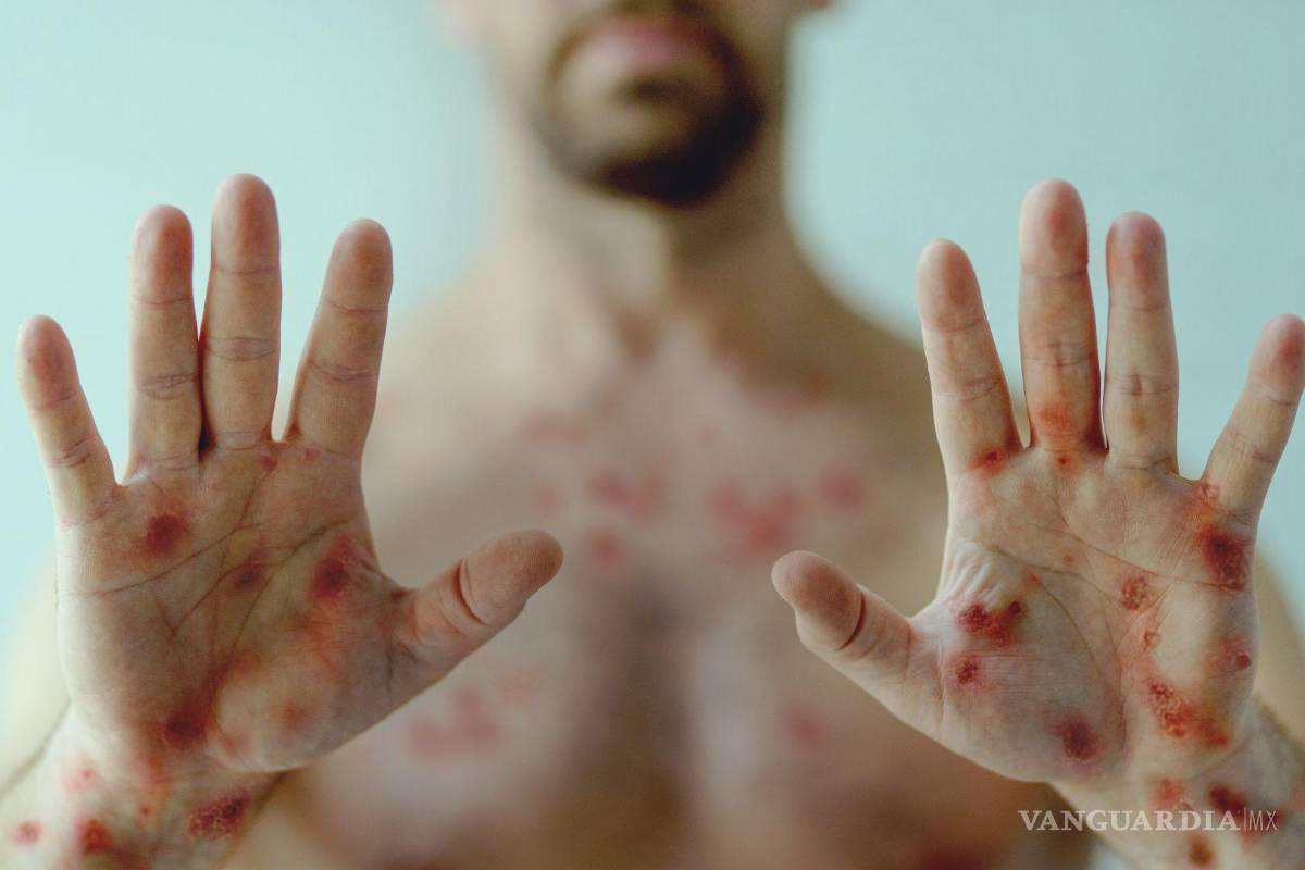 Coahuila libre de Viruela del Mono; da negativo el paciente de Piedras Negras