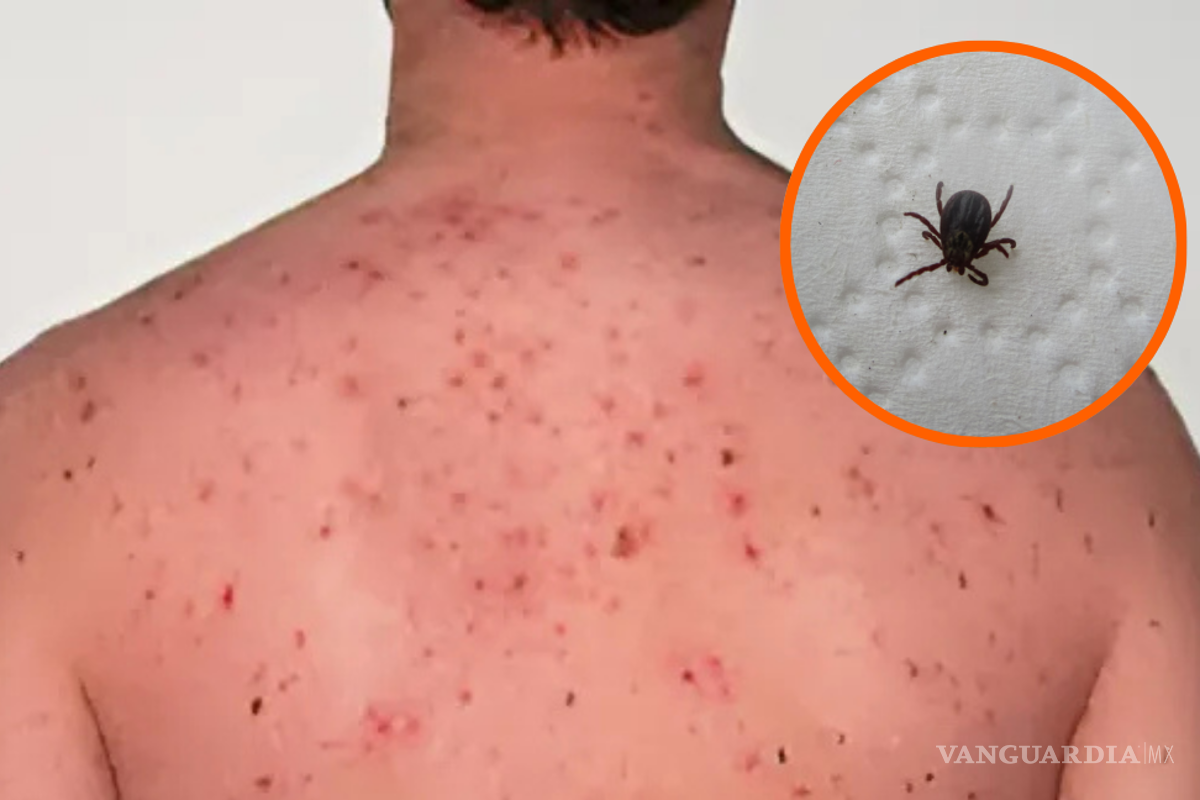 Tamaulipas registra su primer caso de rickettsiosis en 2025; suman 76 casos a nivel nacional
