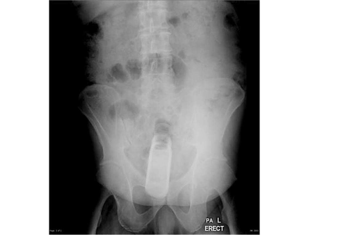 Médicos extraen un frasco de perfume del recto de un paciente en Honduras