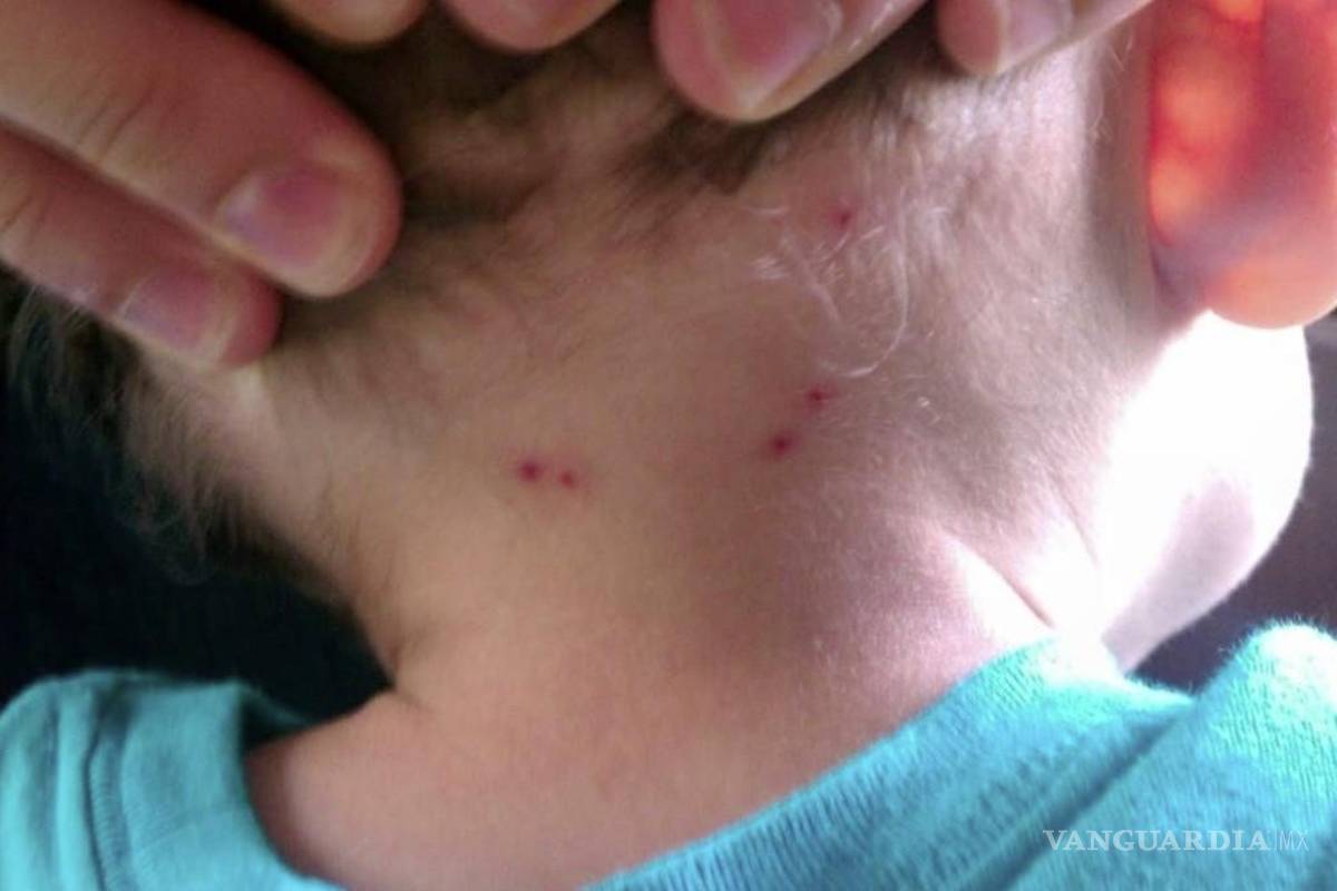 Niños acaparan muertes por rickettsia en Coahuila; autoridades llaman a reforzar medidas de prevención