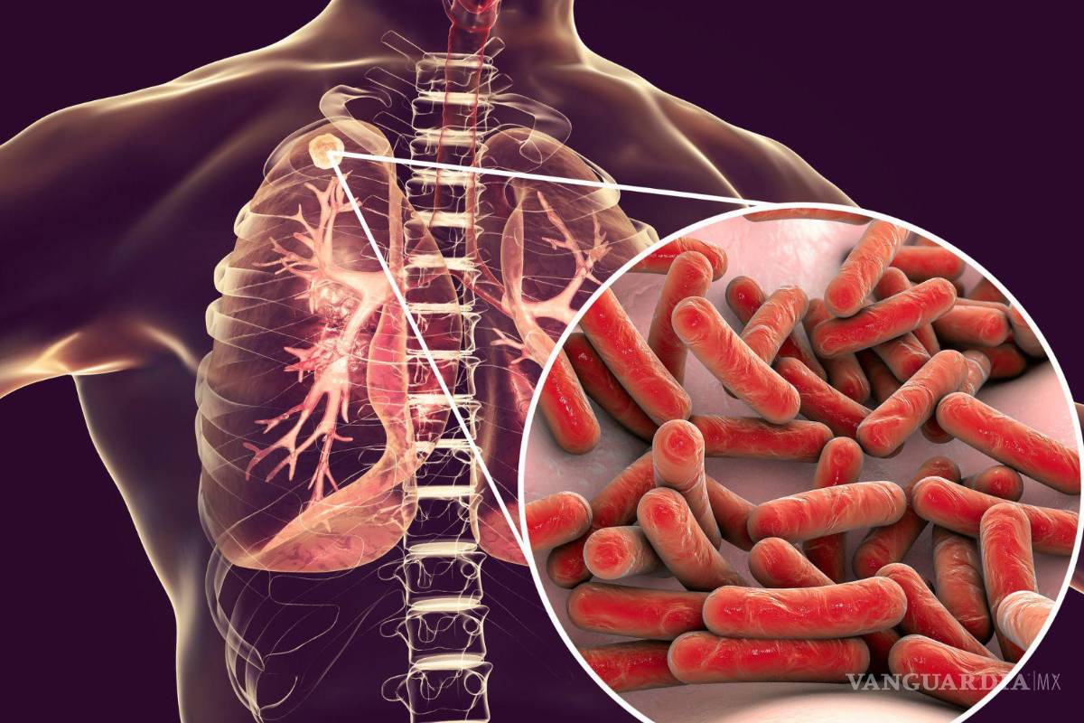 Aumentan casos de tuberculosis en Coahuila; pide UDC fortalecer sector salud para la atención