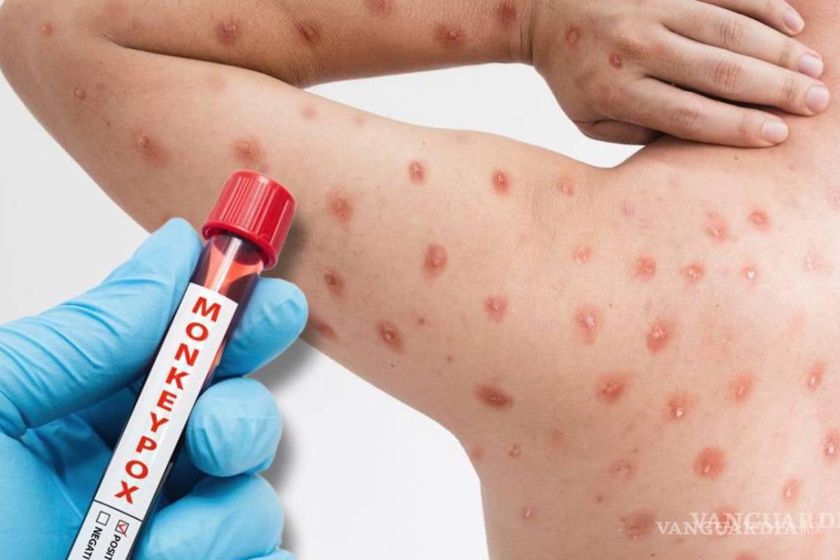 Viruela del mono en Sinaloa: Secretaría de Salud investiga caso sospechoso