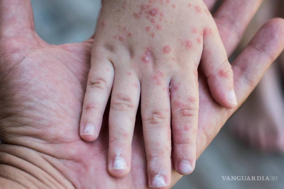 Detectan virus coxsackie en alumno de primaria y cierran escuela en Reynosa por prevención