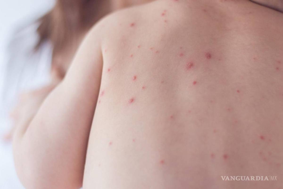 Por mil 400 casos de viruela del mono, Nueva York declara estado de emergencia