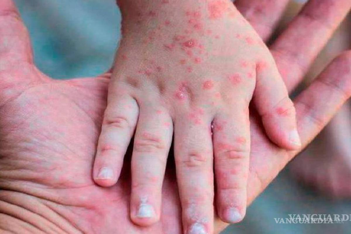 Van 32 casos de viruela del mono en CDMX, reporta Secretaría de Salud