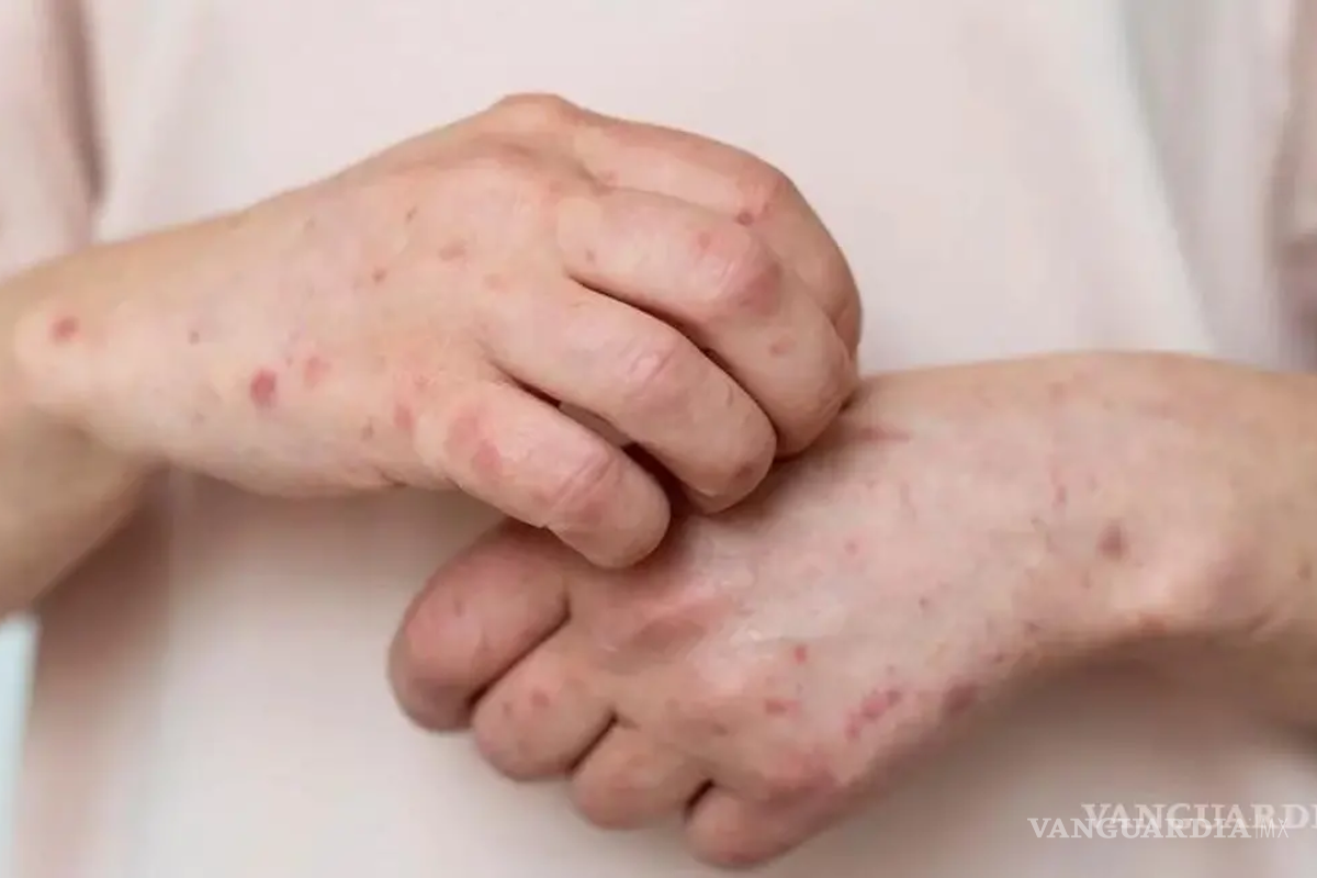 Coahuila: sin vacunarse los 10 casos de sarampión en el Estado