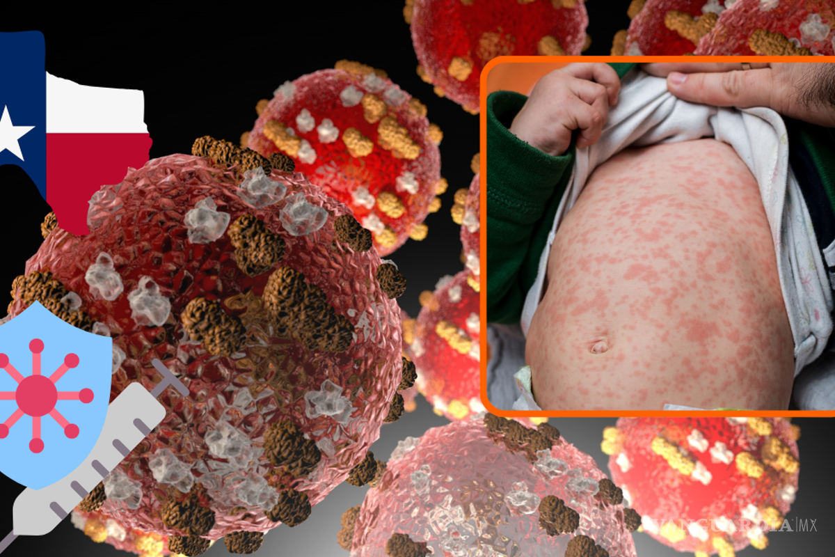 Incrementan los casos de sarampión en los Estados Unidos; punto de riesgo: Texas