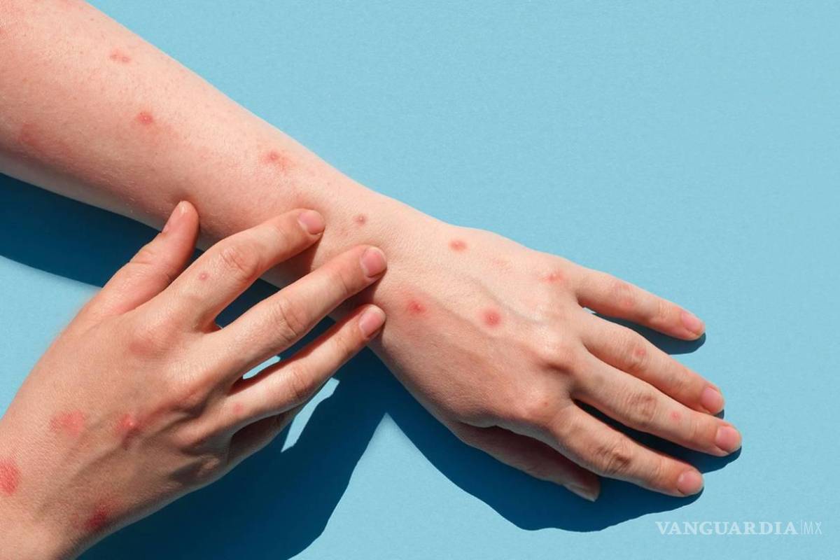 México no solicitó vacunas para atender viruela del mono, asegura la OPS