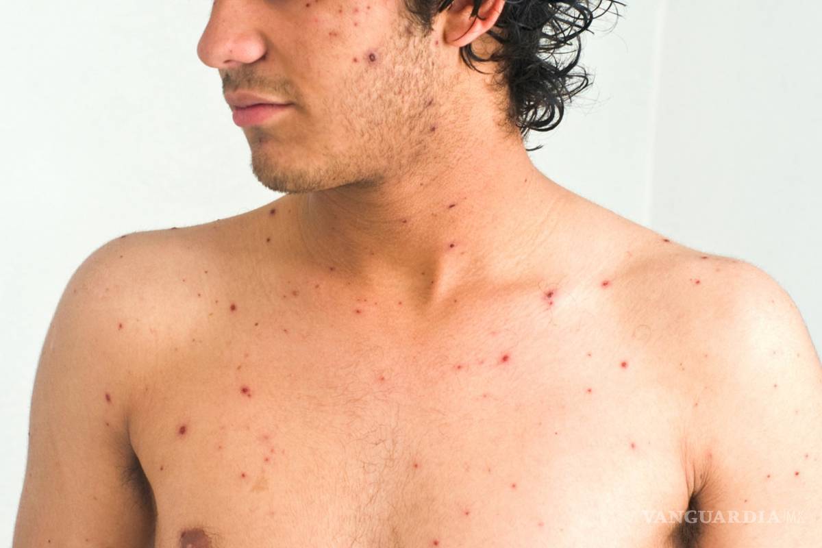 En alerta la frontera de Coahuila por brote de sarampión en Estados Unidos