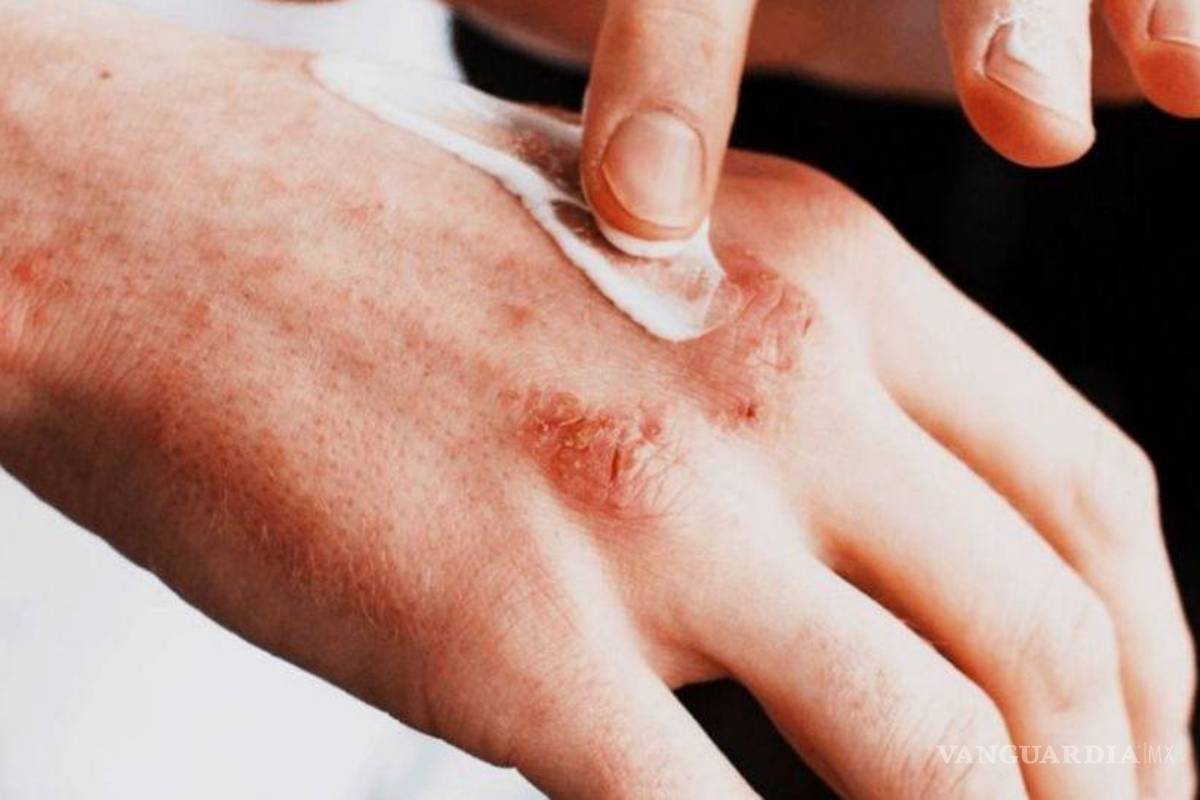 Lepra sería ‘endémica’ en Florida, tras aumento de casos; en México, vigilan 12 municipios