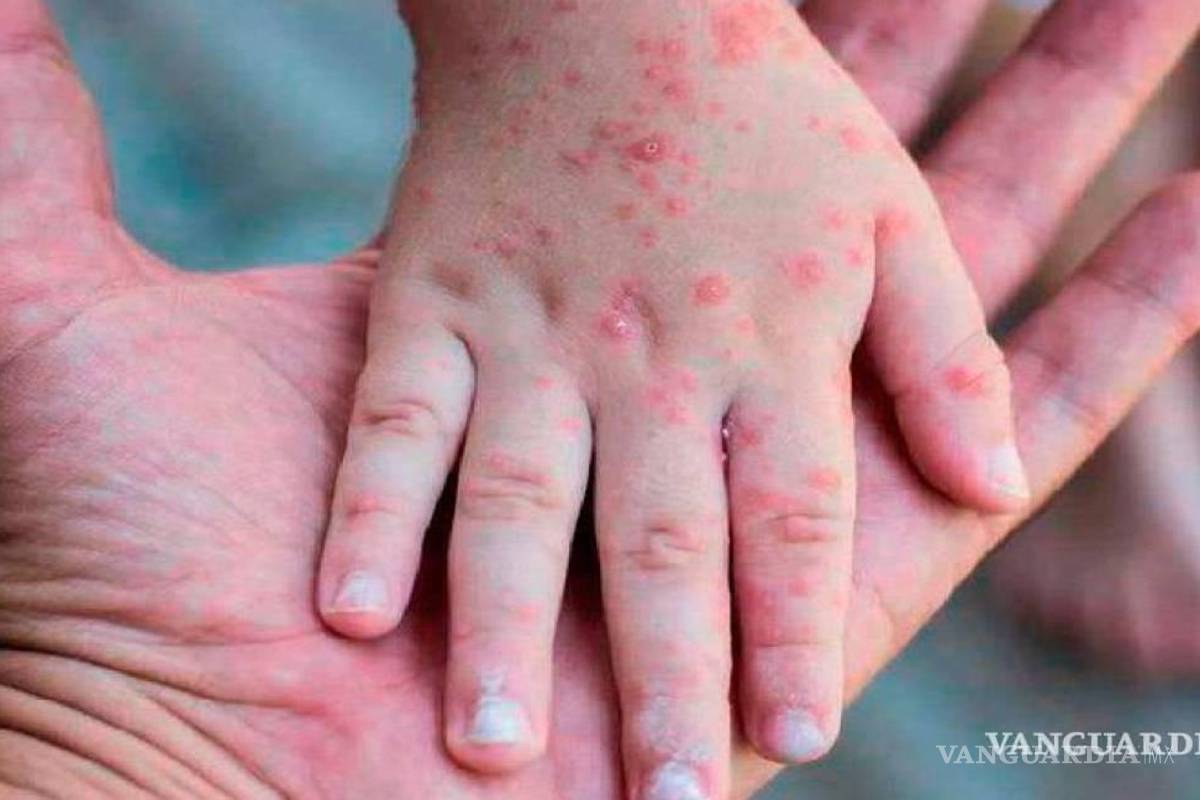 Viruela símica no debe preocupar, no hay casos sospechosos en el estado: Salud Coahuila